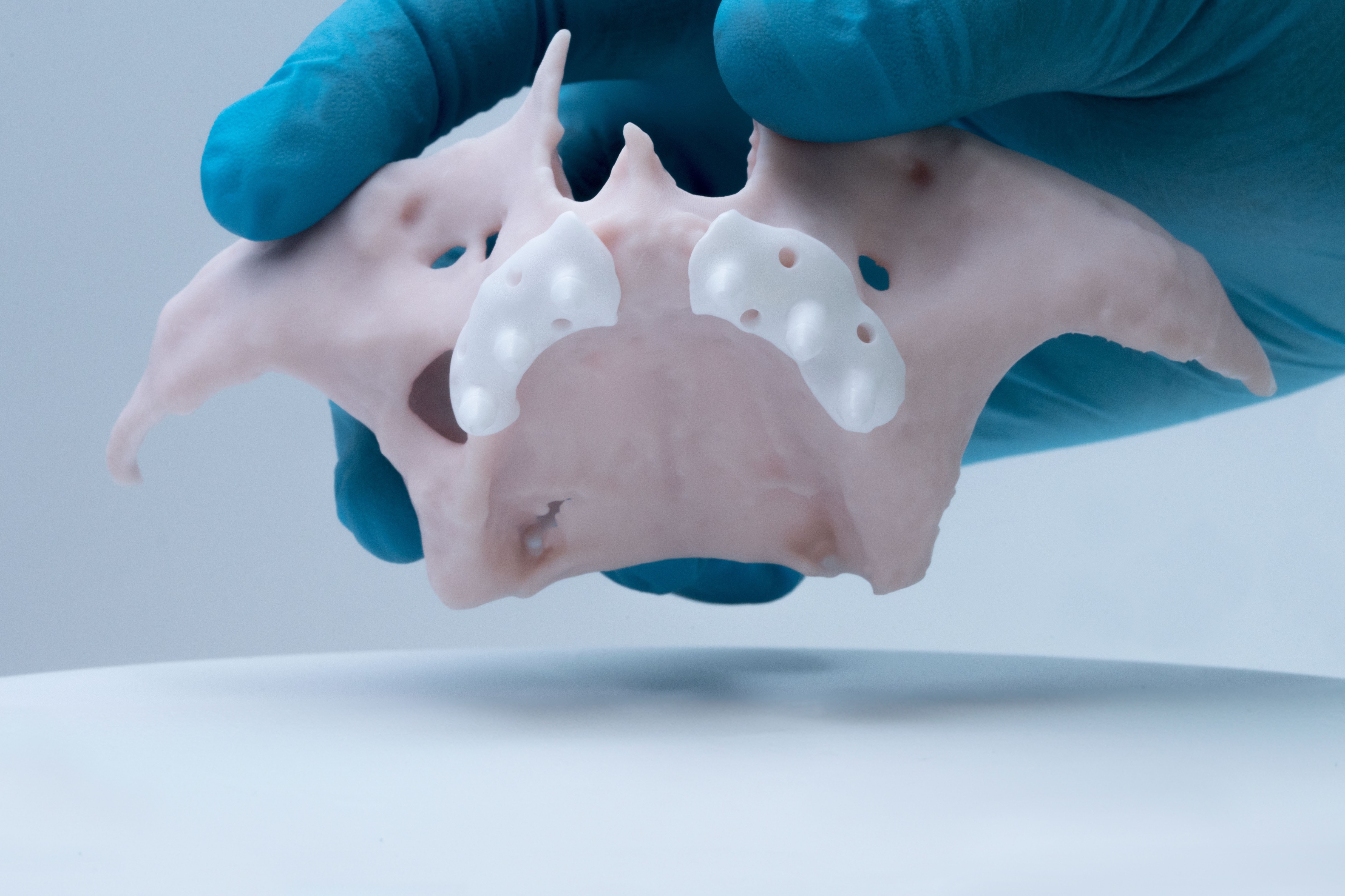 Ceramic subperiosteal jaw implant, 3D printed by Lithoz, is placed in patient for first time ever